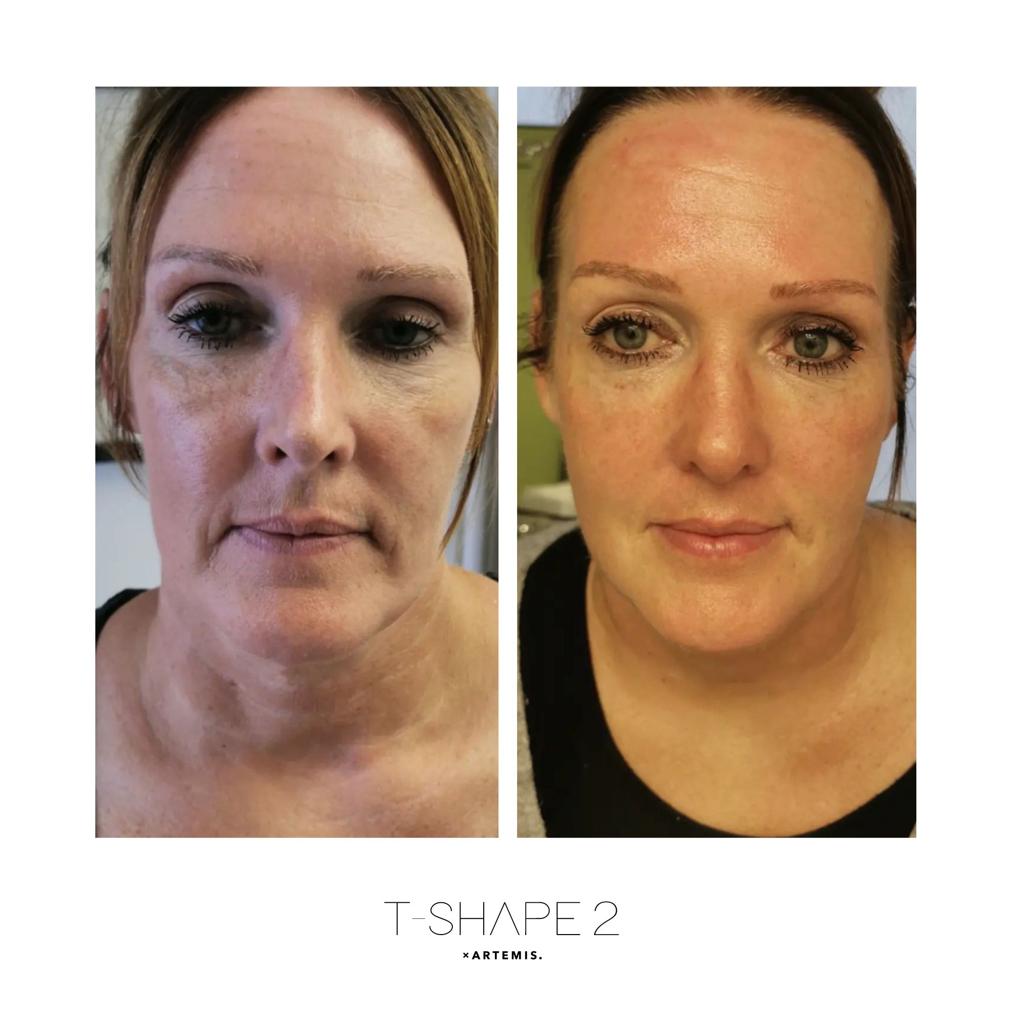 T-Shape 2 before and after — Face & Jawline, After 4 treatments