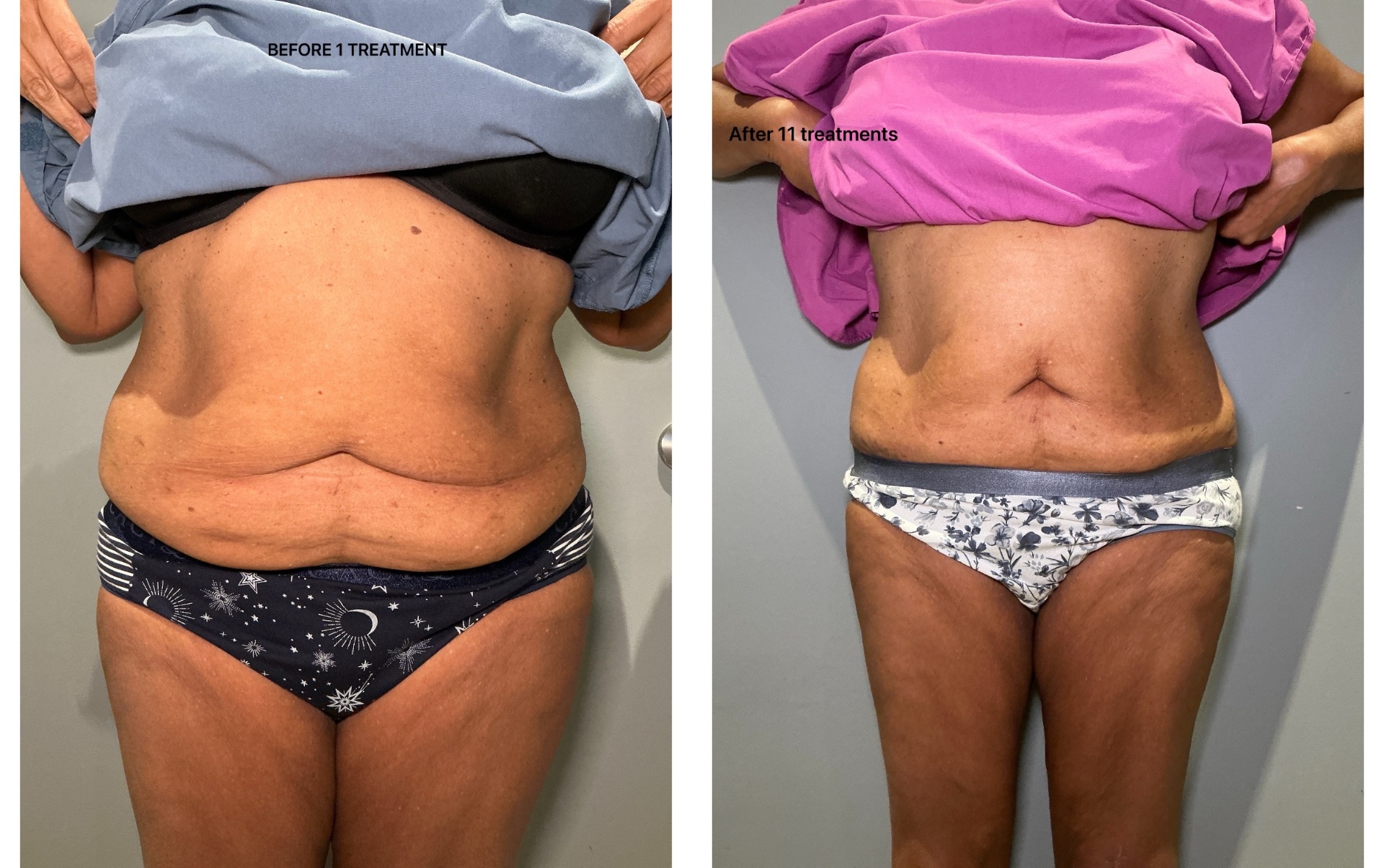 T-Shape 2 before and after — Full midsection, After 11 treatments
