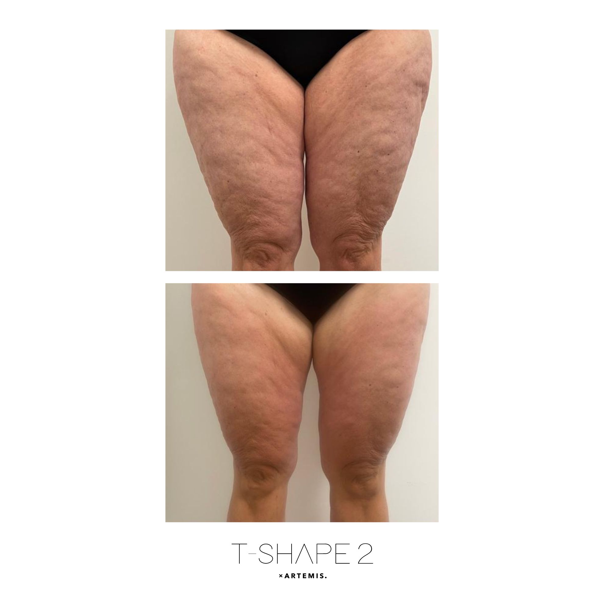 T-Shape 2 before and after — Thighs · Cellulite, After 5 treatments