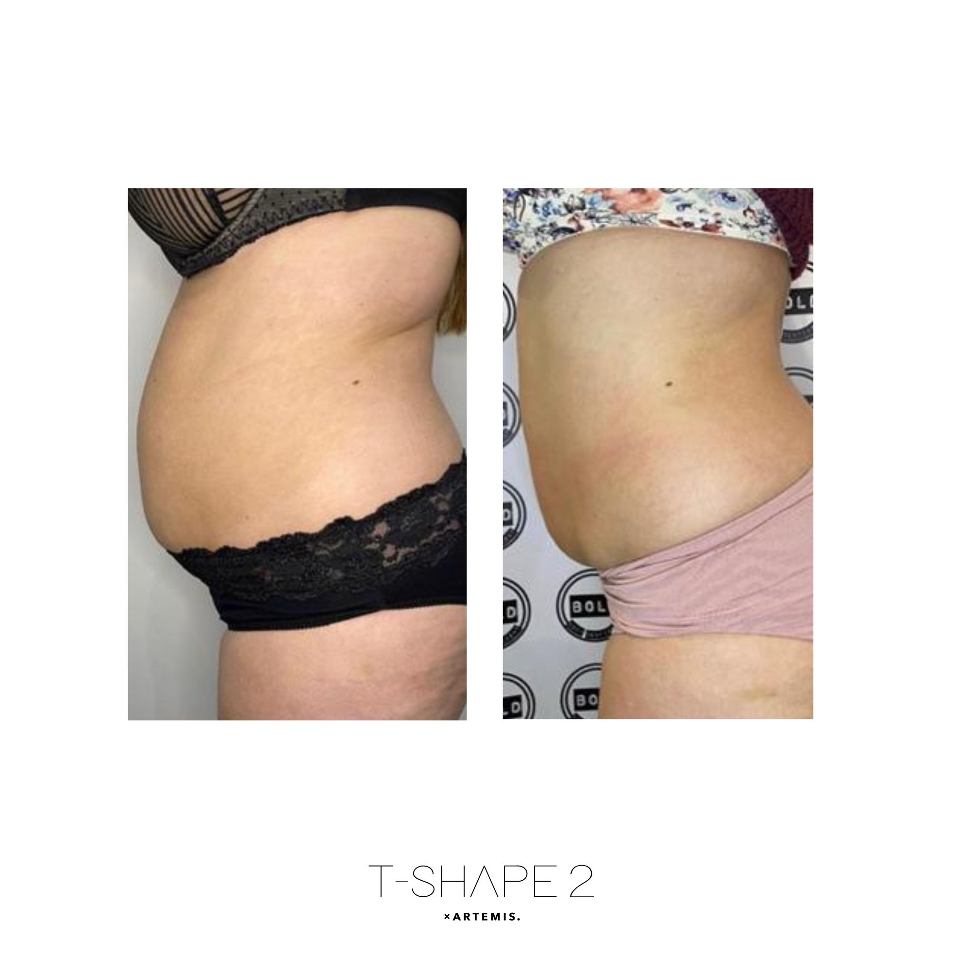 T-Shape 2 before and after — Abdomen · Side profile, After 4 treatments